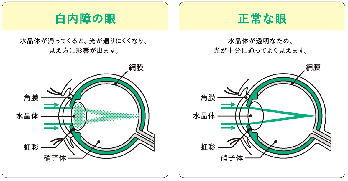 白内障とは